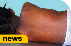 UK Measles Surge