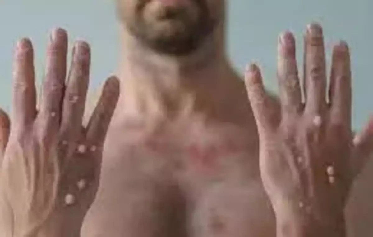 mpox